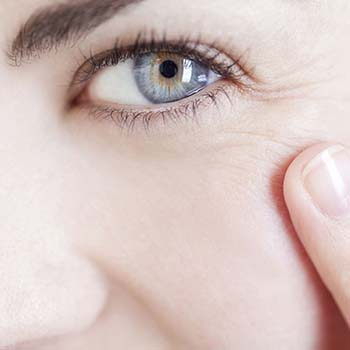 Crow's feet treatment