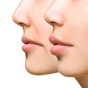 Down Turnned Mouth Corner treatment